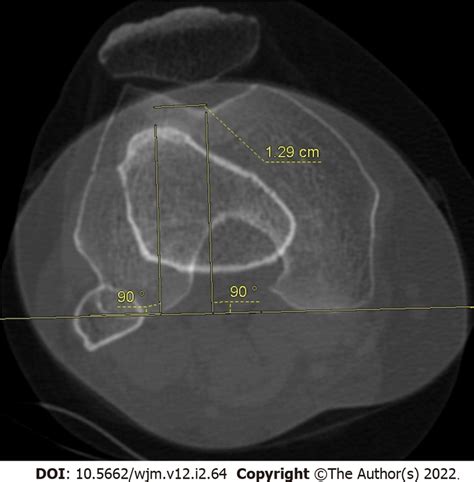 tibia distance